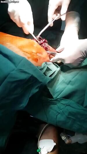 Mortar Shell Removed from Man's Body